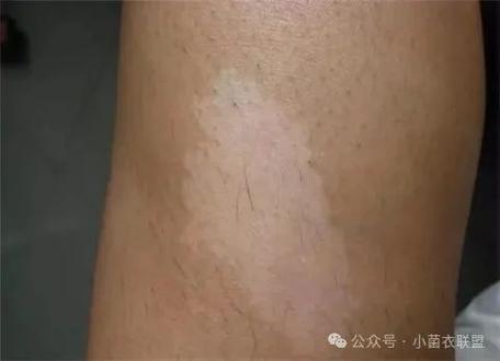 萎缩性白斑能治愈吗?,萎缩性白斑能治愈吗能活多久